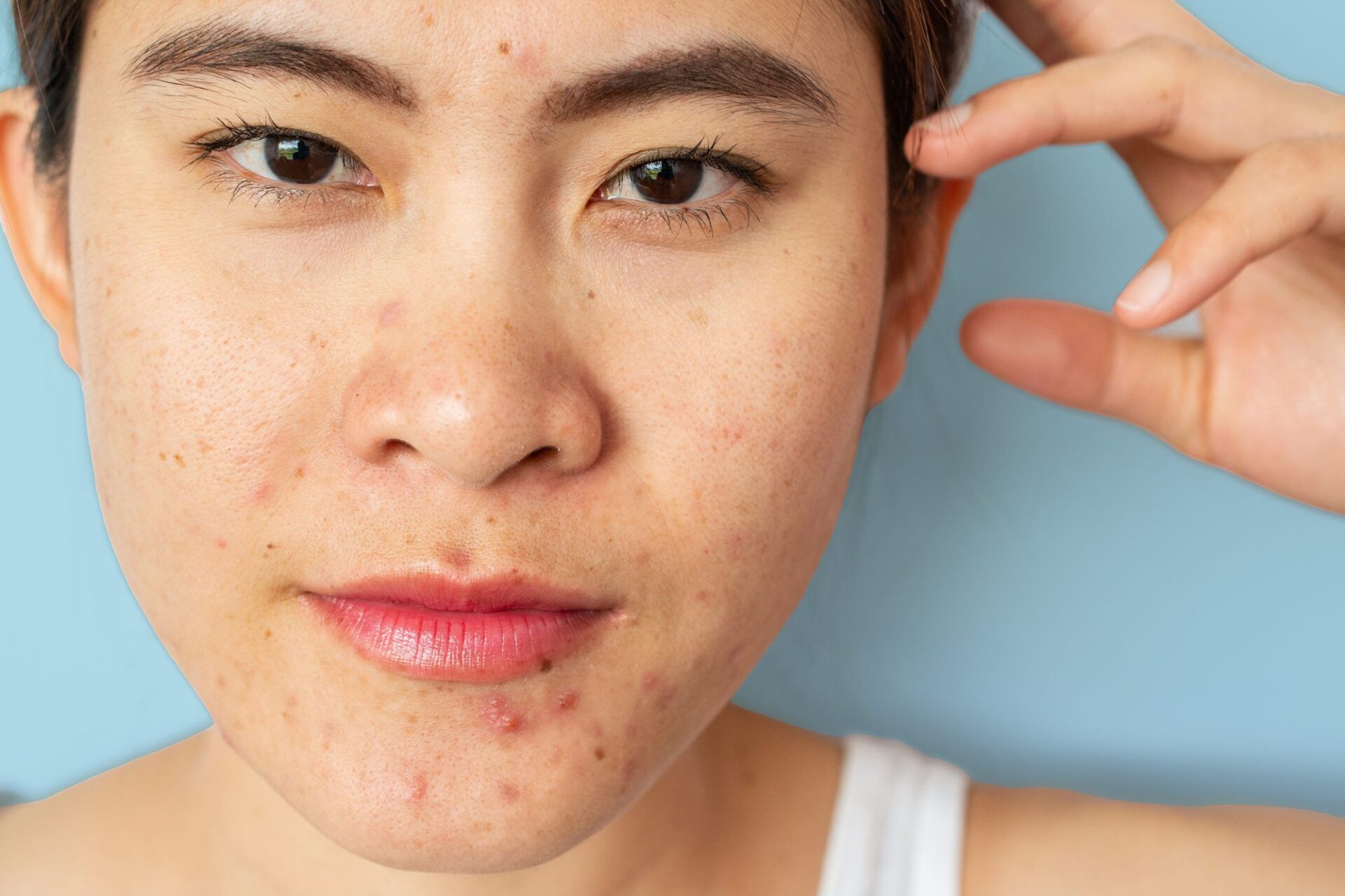 5-ways-to-treat-hormonal-acne-breakouts-mommy-b-knows-best